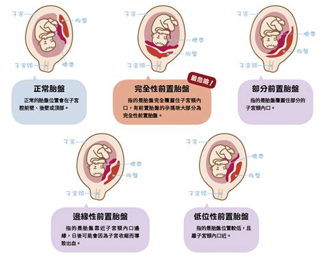 前置胎盤 症狀|前置胎盤有4種，一張圖帶你秒懂｜Mombaby 媽媽寶 